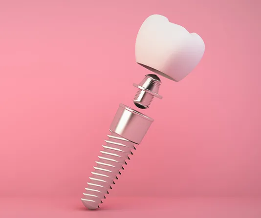 3D render dental implant